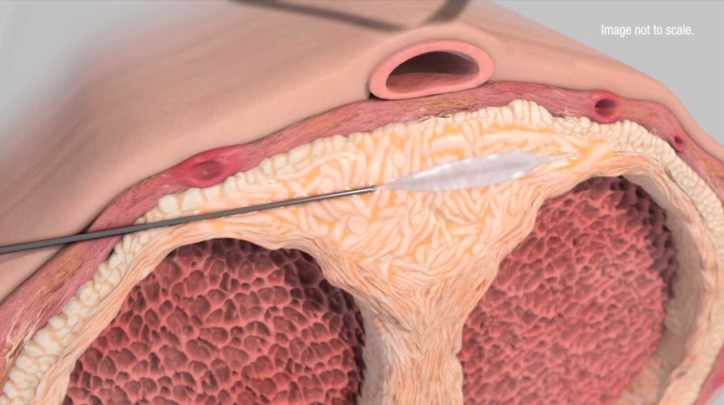 Penis implant surgery vagina photos